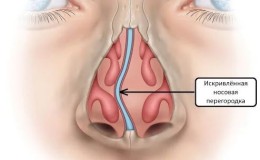 Искривление носовой перегородки