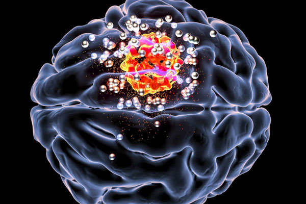 Опухоль головного мозга