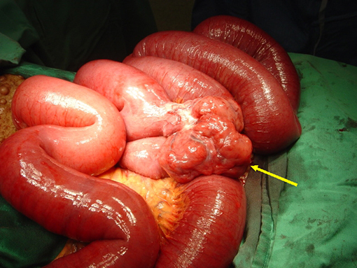 Гастроинтестинальные стромальные опухоли