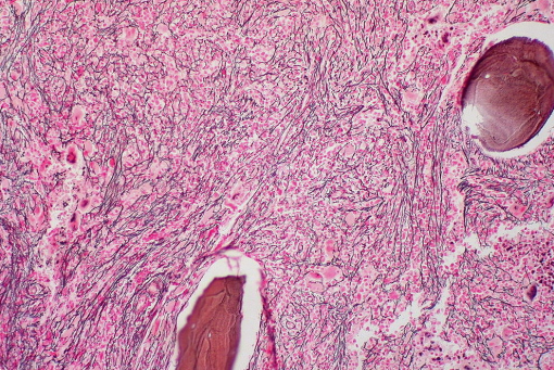 Хронические миелопролиферативные заболевания