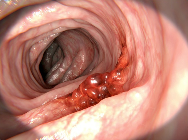 Колоректальный рак