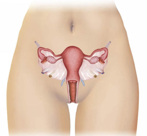 Инфекционно-воспалительные заболевания женских половых органов