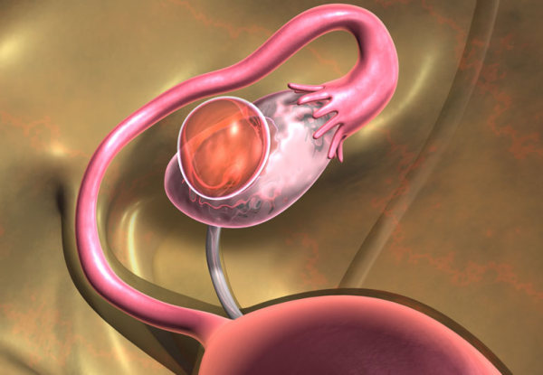 Киста яичника