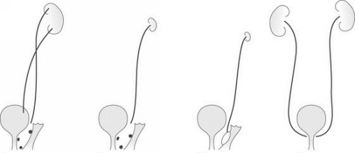 Рак мочеточников