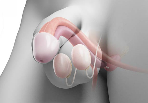 Рак полового члена