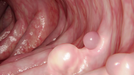 Рак толстой кишки