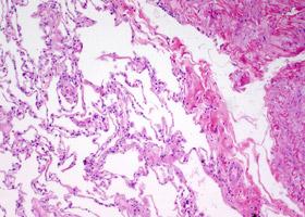 Рак легких немелкоклеточный