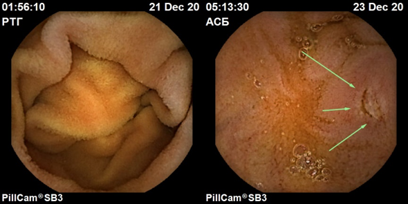 Подготовка пациента к видеокапсульному исследованию толстой кишки