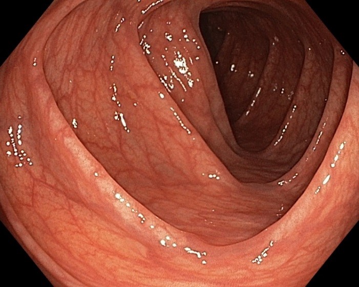 Подготовка к качественному исследованию толстой кишки — колоноскопии