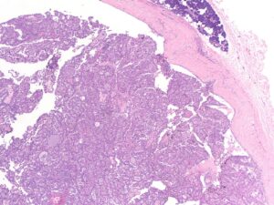 Колоректальный рак — профилактика, стадии, симптомы