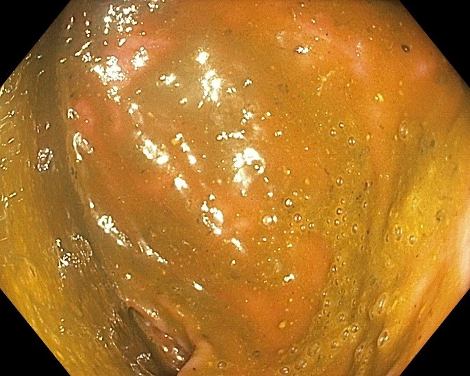 Подготовка к качественному исследованию толстой кишки — колоноскопии