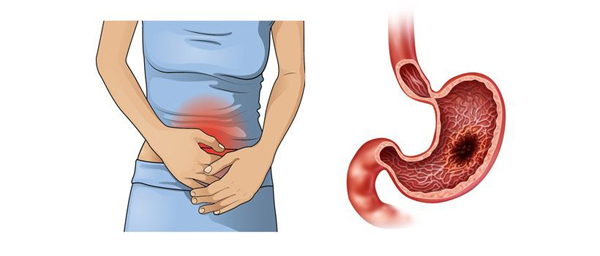 Лечение рака желудка