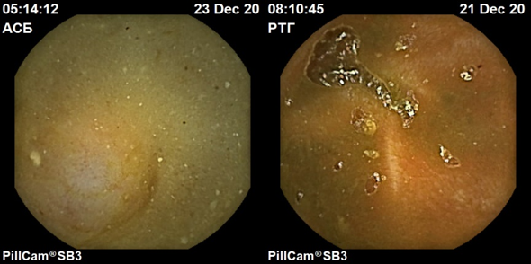 Подготовка пациента к видеокапсульному исследованию толстой кишки