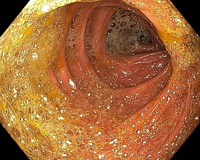 Подготовка к качественному исследованию толстой кишки — колоноскопии