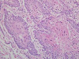 Рак легких немелкоклеточный