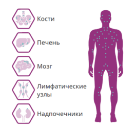 Немелкоклеточный рак легкого (НМРЛ)