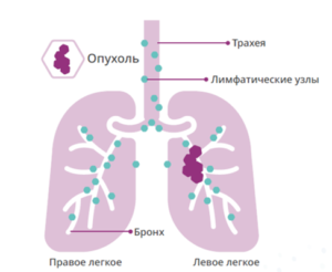 Немелкоклеточный рак легкого (НМРЛ)