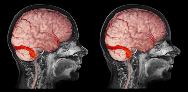 МРТ головного мозга с контрастом