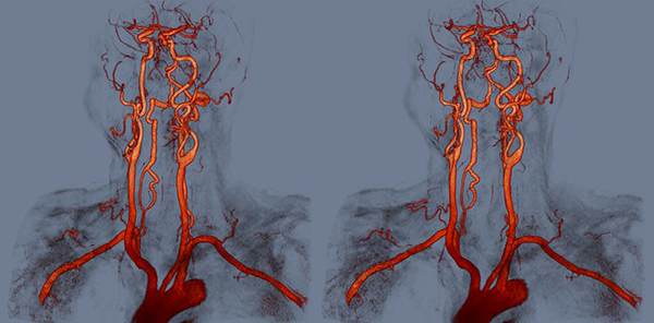 МРТ сосудов шеи