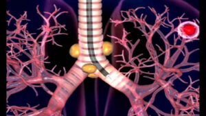 Бронхоскопия при раке