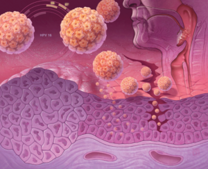 Рак головы и шеи