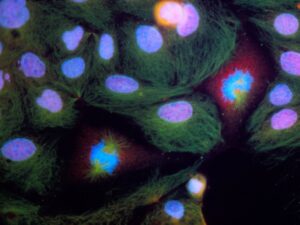 Колоректальный рак — профилактика, стадии, симптомы