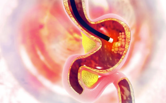 Эндоскопическая диагностика рака