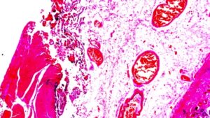 Рак желудка