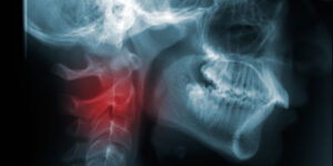 Рак головы и шеи