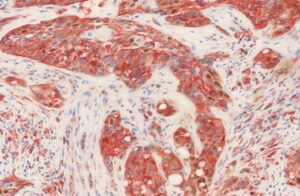 Рак головы и шеи