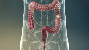 Колоноскопия при раке