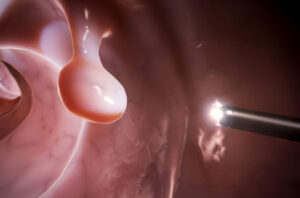 Колоноскопия при раке