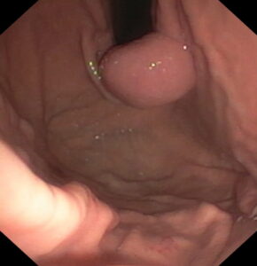 Эндоскопическая ультрасонография (ЭУС)