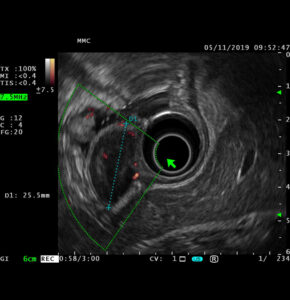 Эндоскопическая ультрасонография (ЭУС)