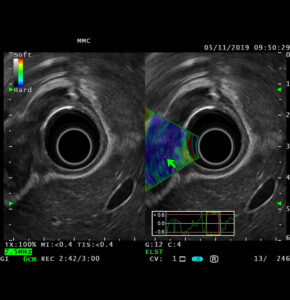 Эндоскопическая ультрасонография (ЭУС)
