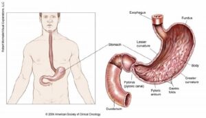 Рак желудка