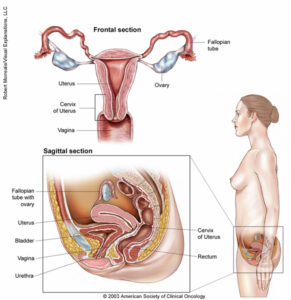 Рак яичника и маточной трубы