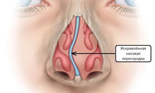 Искривление носовой перегородки