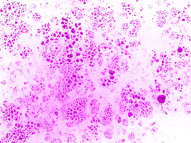 Хондросаркома-2