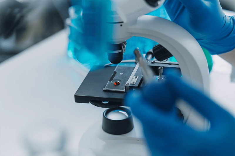 Острый миелобластный лейкоз-7 Острый миелобластный лейкоз-7