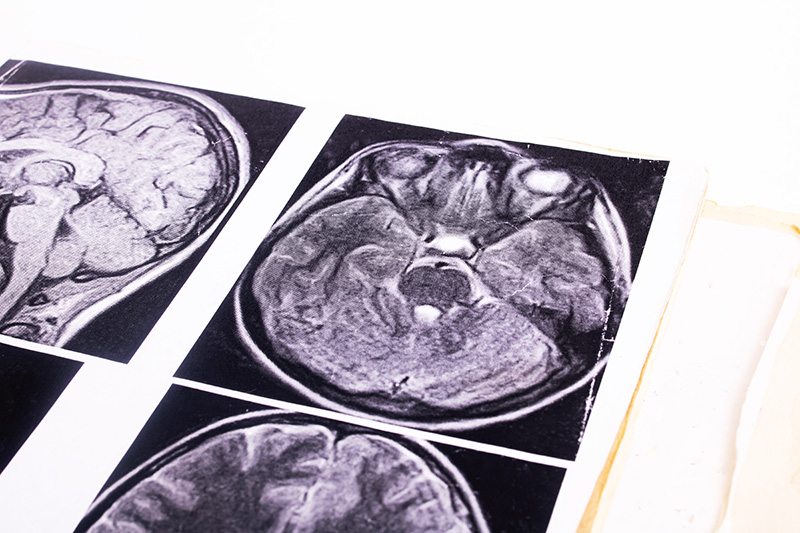 Медуллобластома-1