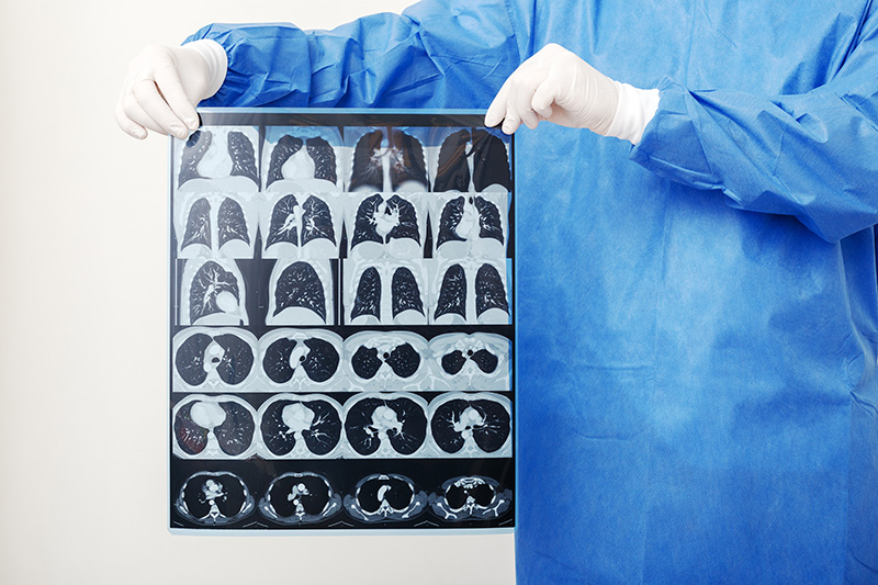 Плоскоклеточный рак легких-1