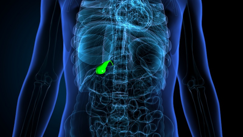 Рак желчного пузыря-3